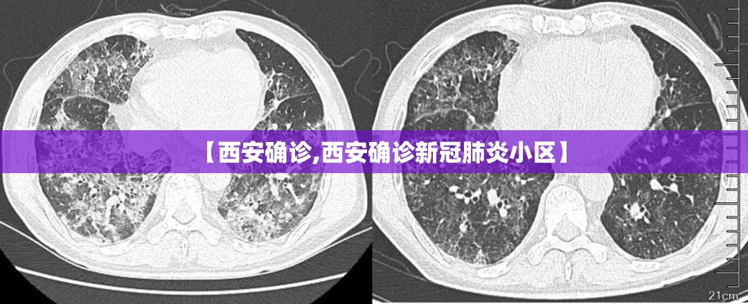 【西安确诊,西安确诊新冠肺炎小区】