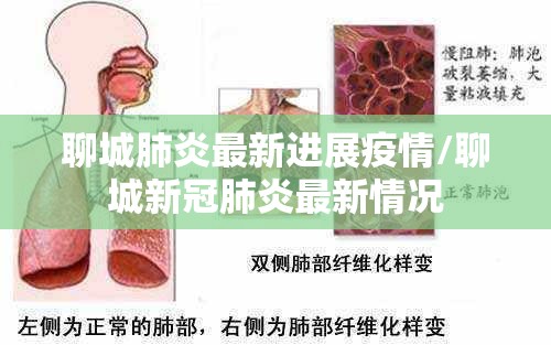 聊城肺炎最新进展疫情/聊城新冠肺炎最新情况 聊城肺炎最新进展疫情/聊城新冠肺炎最新情况