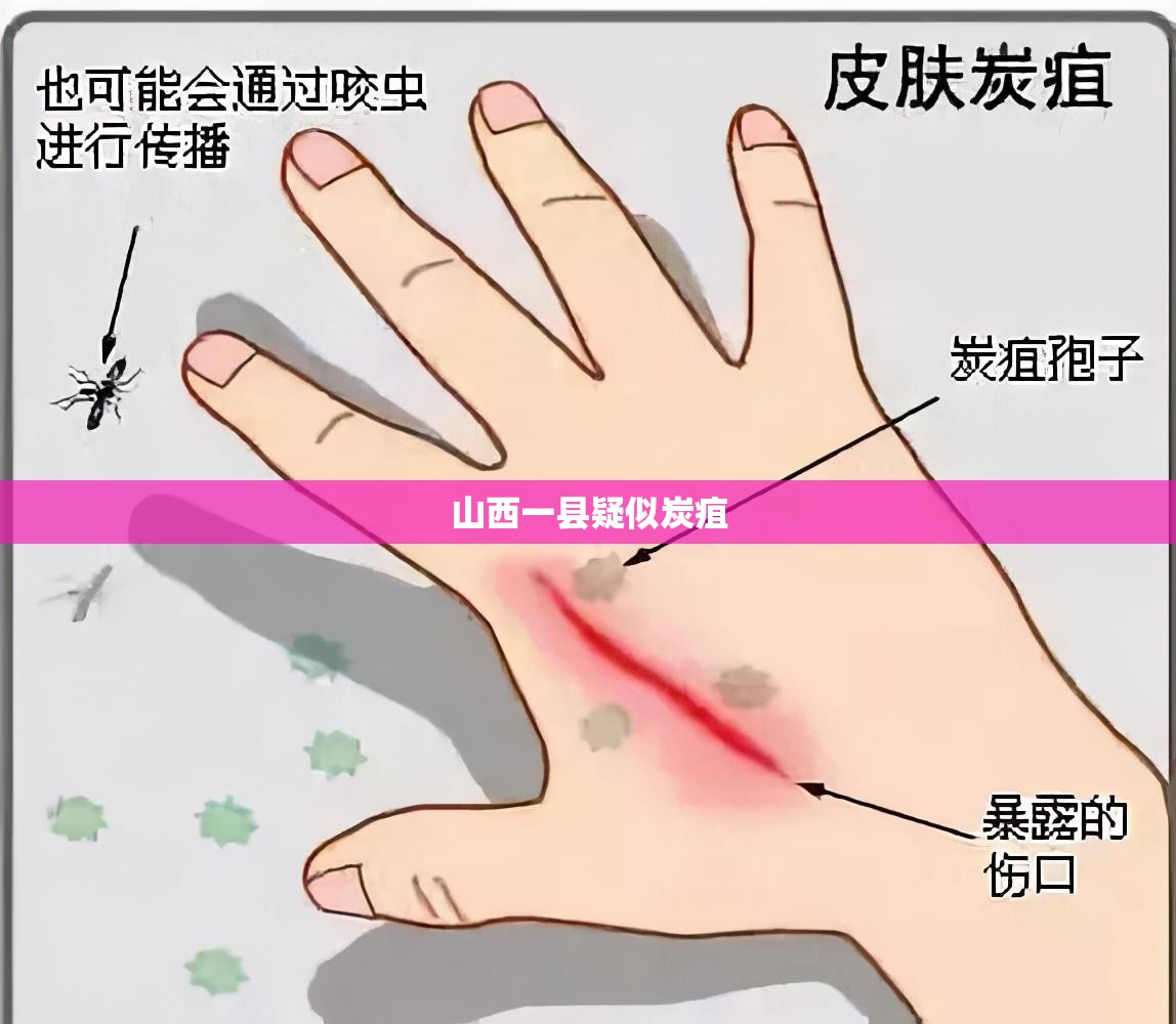 山西一县疑似炭疽/山西炭疽病毒最新消息