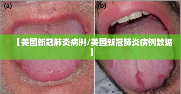【美国新冠肺炎病例/美国新冠肺炎病例数据】