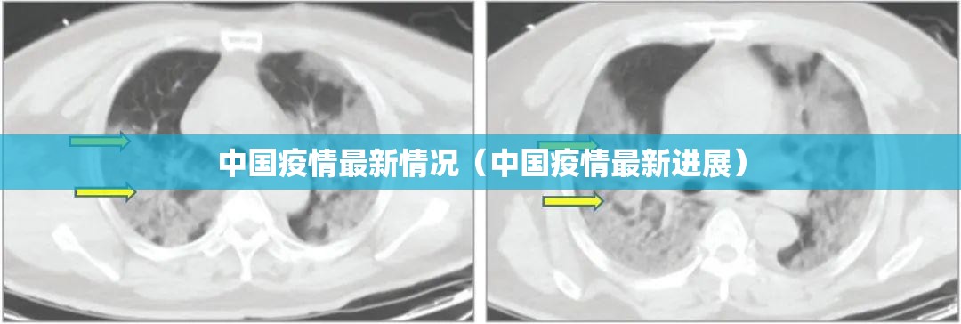 中国疫情最新情况(中国疫情最新进展) 中国疫情最新情况(中国疫情最新进展)
